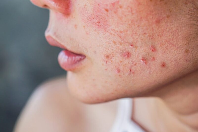 Pitting Acne On Your Face How to Get Rid
