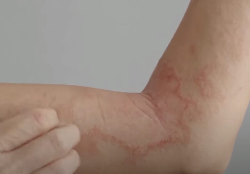 Eczema and Dry Skin