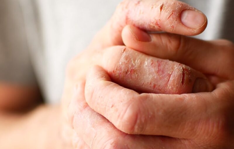 Eczema vs Dry Skin